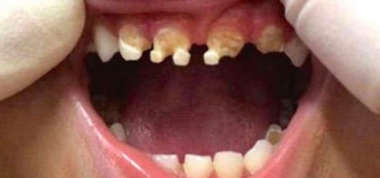 Když doktor viděl zuby 3letého chlapce, rozhodl se přes sociální síť varovat všechny rodiče...