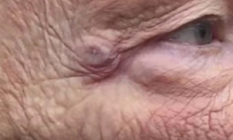 Tak vypadá akné na tváři, kterého si léta nevšímáte. Motivace, proč si každý den čistit pleť