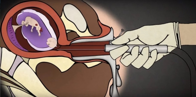 Jednoduchá animace ukazuje, jak ve skutečnosti probíhá potrat. Co si o tom myslíte vy?