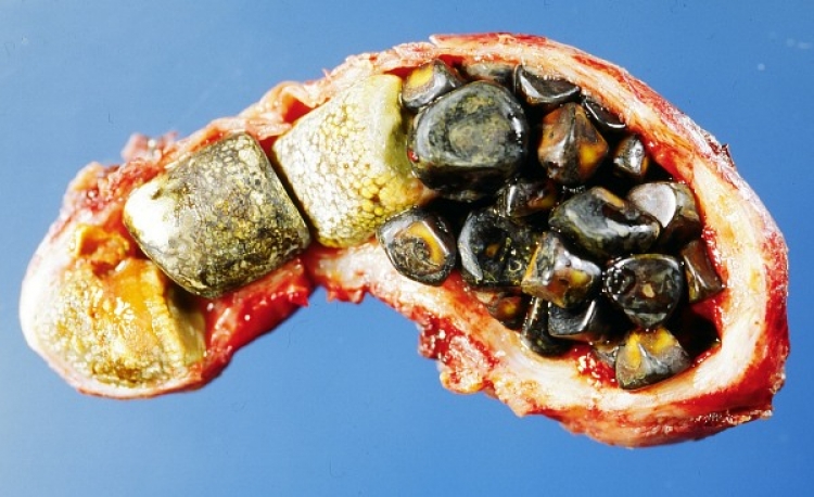 Čínský doktor prozradil tajemství, jak se jednoduše zbavit žlučníkových kamenů za 7 dní