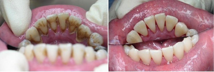 Udělejte toto jednou týdně a vaše zuby budou bílé jako perly, dokáže zastavit každý stav onemocnění v ústech a zápach z úst